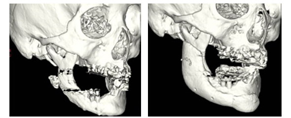 3Dプリンターによるカスタムメイドの人工骨について、薬事承認を申請